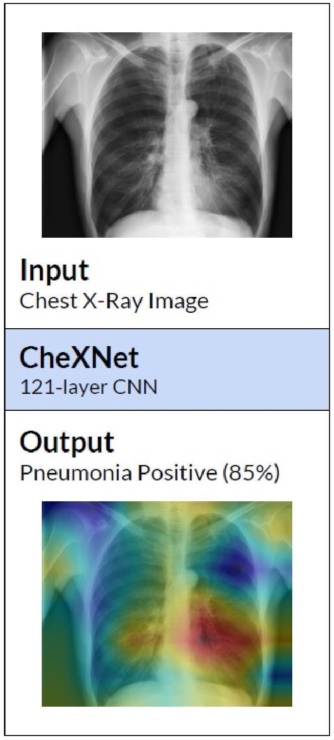 Stanford CheXNet Deep AI machine learning Detect 14 lung conditions based on chest x-ray