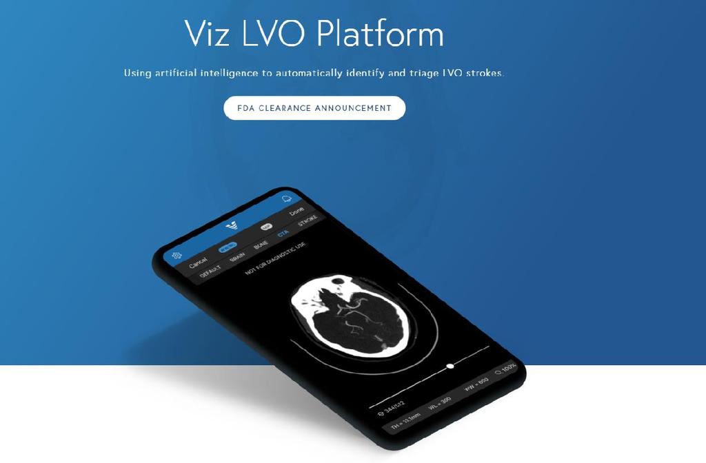 Viz LVO diagnostic AI Designed to detect stroke AI algorithm analyzes CT scan brain images Automatically