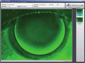 Taking measurements with placido ring illumination The cornea is represented across its entire surface and globally using thousands of