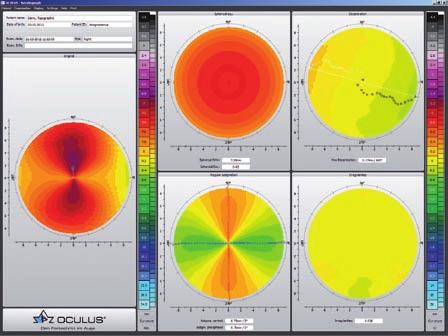 Fourier analysis The Fourier analysis is an important tool for visualizing the amount of corneal irregularities. Using the Fourier analysis, the topography map is divided into individual components.