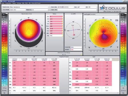 Zernike analysis Irregularities of the cornea can be depicted clearly with Zernike analysis.