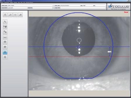 Keratoconus. Compare 3 exams With this feature, up to 3 examinations can be displayed and compared side-by-side.