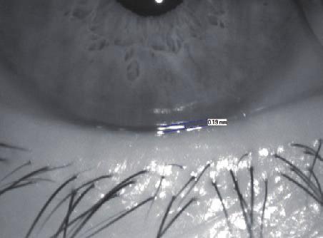 examined carefully. Only an intact tear film guarantees contact lens wearing comfort!