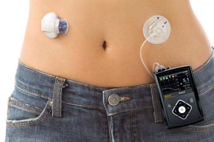 First artificial pancreas : Medtronic Minimed 670G (launched 2017)