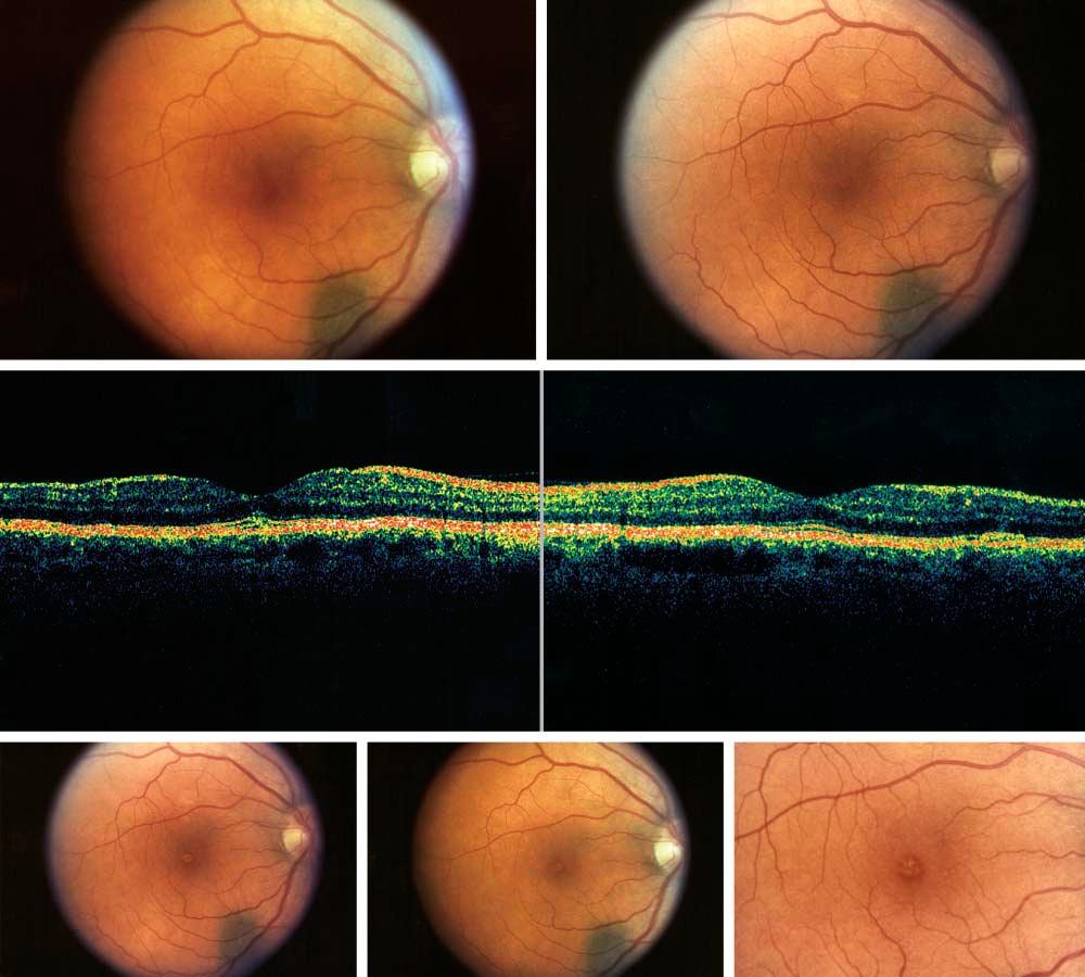 A B C D E F Figure 1. Composite showing the fundus photographs and optical coherence tomographic images before and after exposure to the green laser pointer. A, Normal-appearing macula.