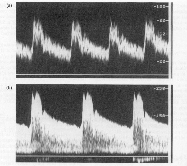 Spectral analysis applications Detection of stenosis a. Healthy subject b.