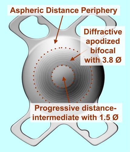 Refractive zone of Progressive power for Far to Intermediate foci within 1.5 mm diameter Apodized Diffractive zone for Far and Near foci within 1.5-3.
