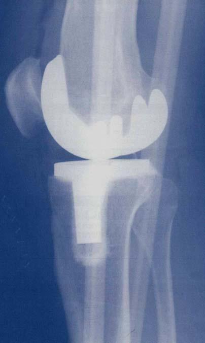 for surgical implants ( knee and hip