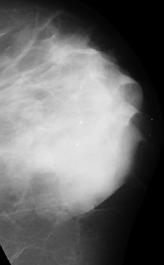 Original mini-mias image "mdb00"; Registered image with removed background and pectoral muscle; Extracted ROI from the same image which will be filtered using Gabor filter.