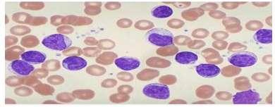 2.3 Leukemia Blood Structure:- White Blood cells in human body are employed to protect the body from infections and outside attackers including viruses, bacteria or any other invaders.