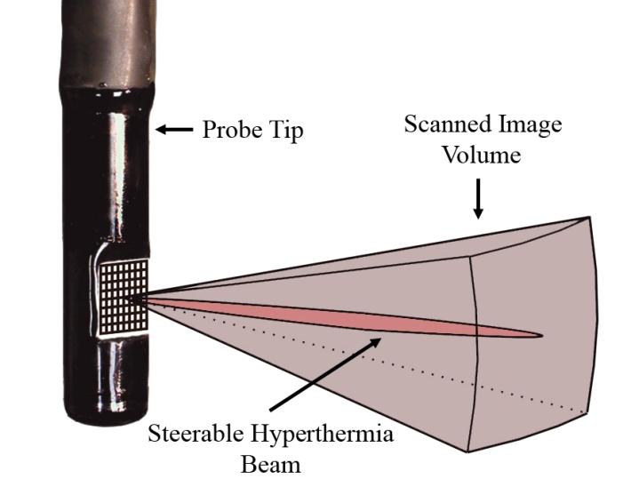 2 PUA ET AL FIG. 1 Ex am ple of a com bined 3D ul tra sound im ag ing and hyperthermia de vice.