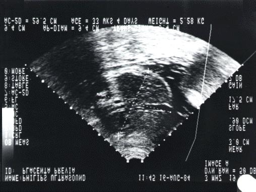 Figure 6: Example of a sector scan (placenta previa) The flow map can be superimposed on the echo image (colour coded flow mapping).