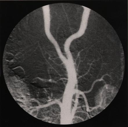Figure 11: DSA image of the bifurcation of the aorta Since the contrast medium is injected in the form of a bolus in the first subtraction images, the proximal part of the vessel tree is usually