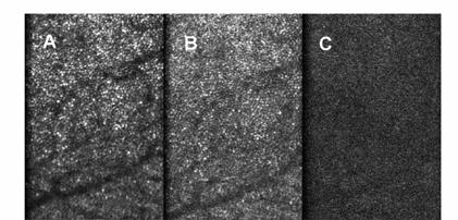 Figure 7. Example of the imaging performance of the adaptive optics system. All images are single frames of video. A- uncorrected, best focus image of the retina of a 43 yo female subject. B.