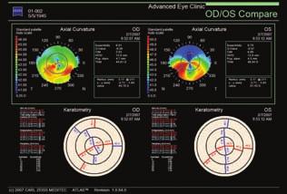 visual acuity Data Automatically display preferred parameters such as simulated keratometry,