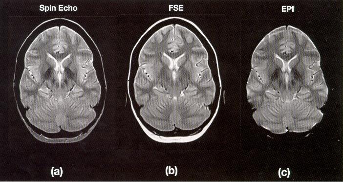 (b)figure 2.2: (a) Non fat suppressed and (b) fat suppressed EPI of brain. Figure 2.