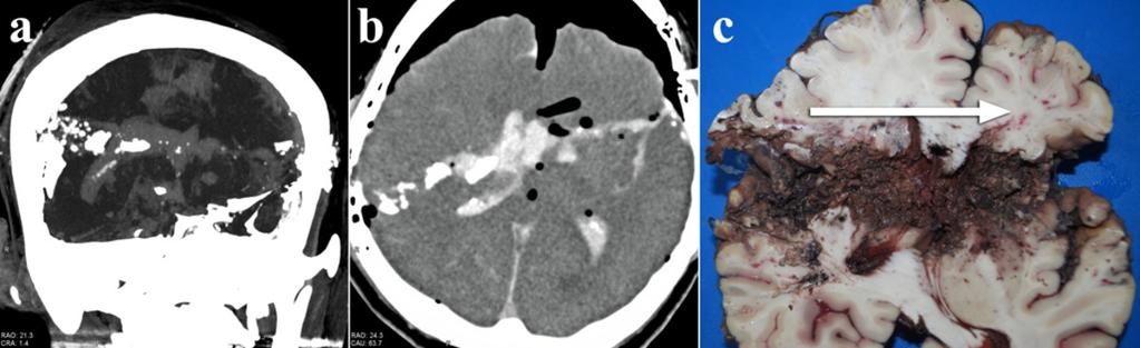 Fig. 3: Figure 3. CT images of the head and photograph of the formalin fixed brain in Case2. a. MIP coronal image of hematoma and bone fragments along the trajectory path. b. MPR brain image shows a clear bullet track through the brain from the right to left temporal regions.