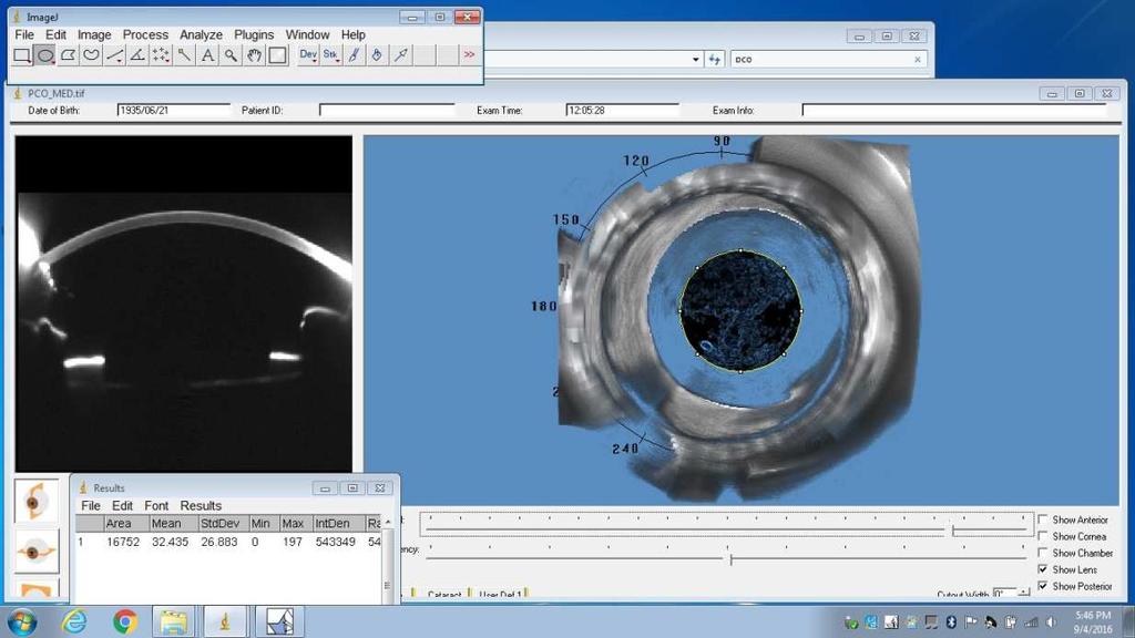PCO, OBJECTIVE MEASURING Rotating Scheimpflug camera (Pentacam HR, Oculus) Density value of PCO on Scheimpflug slit image Pixel intensity using ImageJ64 medical imaging software Area inside the
