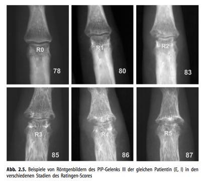 Rheumatoid Arthritis: Joint Erosions R. Rau, S.