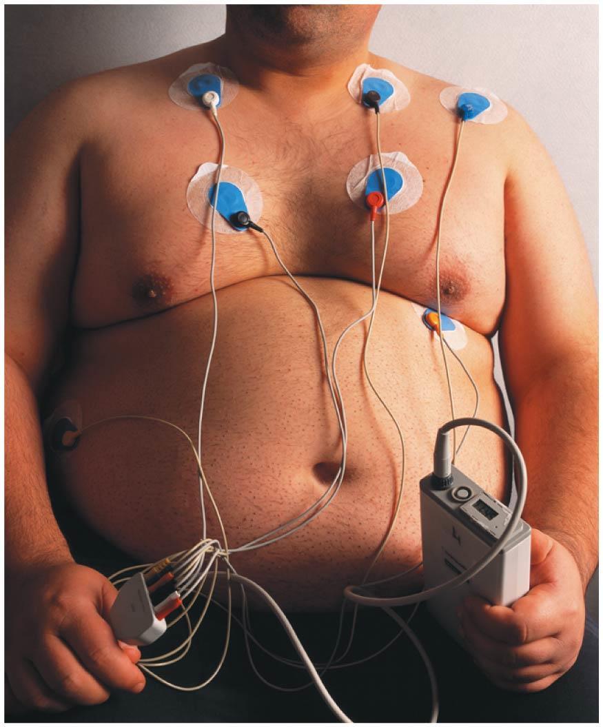 Measuring body fat by bioelectric impedance analysis The electrodes attached to this overweight patient s chest are applying a small ac voltage of frequency 50 khz.
