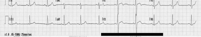 Electrocardiography (ECG) Signal - Represents