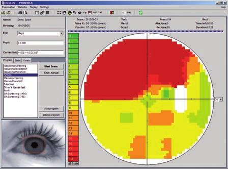 Fighting Glaucoma Measurement Assessment Progression The First Step: Screening for Glaucoma Using perimetry for glaucoma screening customarily involves performing supra-threshold examinations of the
