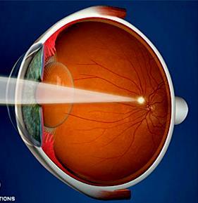Laser radiation hazard assessment Laser and other collimated light sources can be focused by the eye to a very small focal spot and can create a high power density on the retina 2 mw laser
