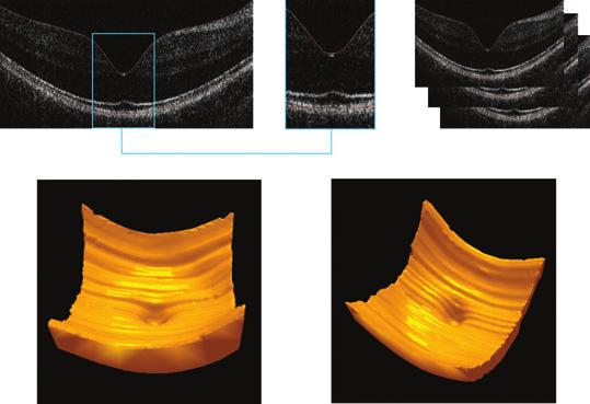 of Vienna) delineated the ILM and the contour of the RPE layer to obtain the retinal volume in each B-scan.