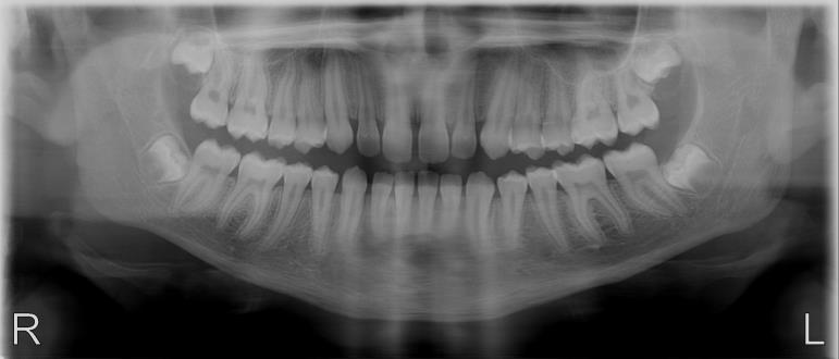 Lateral TMJ in normal occlusion and maximum opening Front view of maxillary sinuses 7 s 7 s 4.9 s 2 x 2.2 s 12 s A.