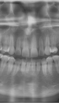 P5 Program: Anterior Teeth Anterior Teeth: Program duration