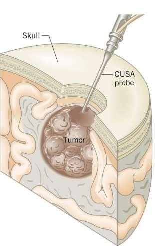 Applications of Sound in Medicine Neurosurgeons use a cavitron ultrasonic surgical aspirator