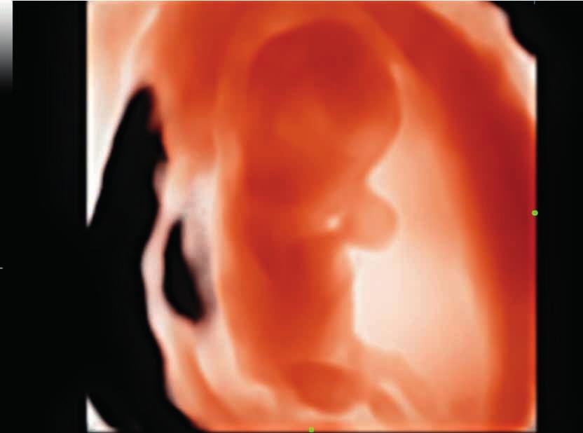 3D Fetal