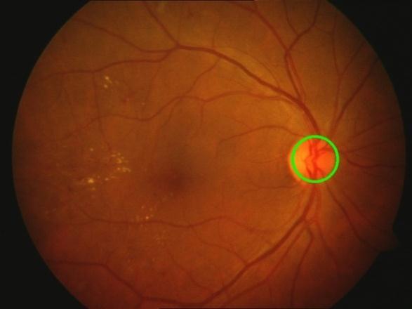 This action is followed by dilation to compensate for the loss of the borders of bigger blobs that are possible candidates for being the optic disc.