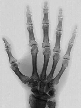 joint (MCP) Interphalangeal joint (IP) 15 movable