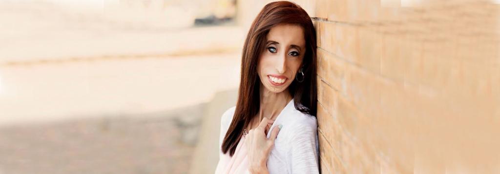 4. LIZZIE VELASQUEZ THE WORLD S UGLIEST WOMAN Take a photo of this lady and ask students : a. Do you know this woman? 3 minutes She has a disease by which her body cannot store any fat.