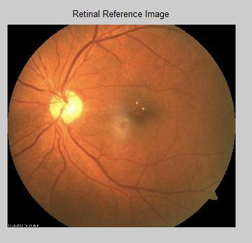 The matching of the expected directional pattern of the retinal blood vessels is used as OD detection algorithm and the retinal blood vessels are segmented using a simple and standard 2-D Gaussian