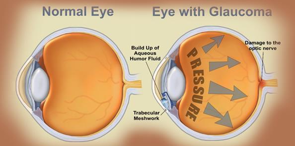 ISSN: 0976-9102 (ONLINE) ICTACT JOURNAL ON IMAGE AND VIDEO PROCESSING, FEBRUARY 2017, VOLUME: 08, ISSUE: 03 following figure Glaucoma symptoms shows the normal as well as Glaucoma affected Retina.