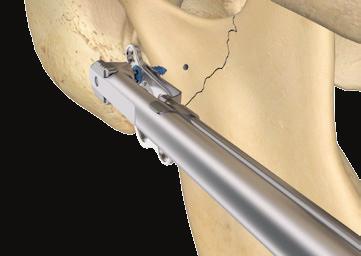Insertion of the implants To implant the first screw, the turning handle is first attached to the angled screwdriver.