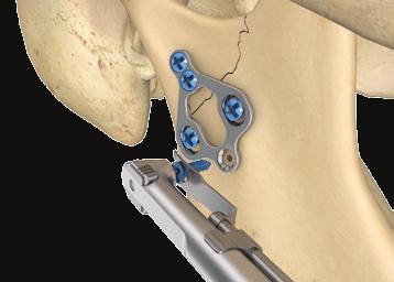 Once the surgeon has convinced himself/herself of the correct anatomical position of the condyle or the cranial fragment, then this position can be secured successively with further screws in the