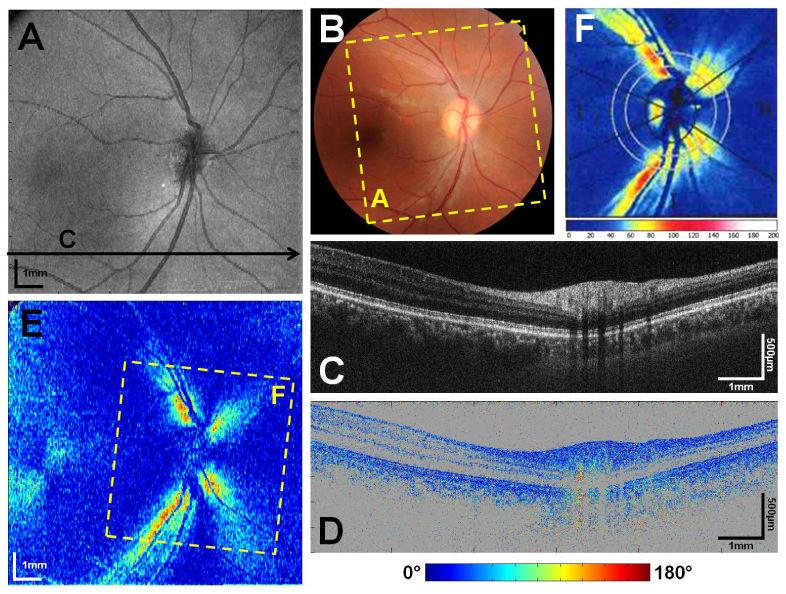 Baumann et al. Page 15 Fig. 3. Wide field PS-OCT imaging of the human retina. (A) Fundus projection image.