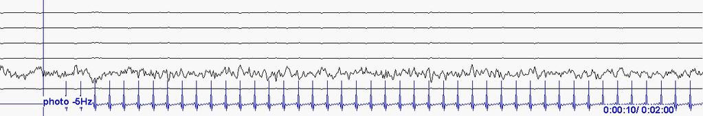 Registration of signals used for the analysis The signals used for the analysis have been registered using the TruScan 32 EEG system, which is used for registering, analyzing and filing of EEG.