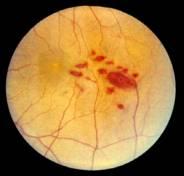 Laser-Induced Retinal Hemorrhage Thresholds Compared to the Minimum Visible Lesion Thresholds ED 50 - mj l 1Hr 24Hr Hemor. 410 77 49 110 420 27 24 31 430 18 15 27 442 17 13 21 450 8.4 6.9 32 458 6.