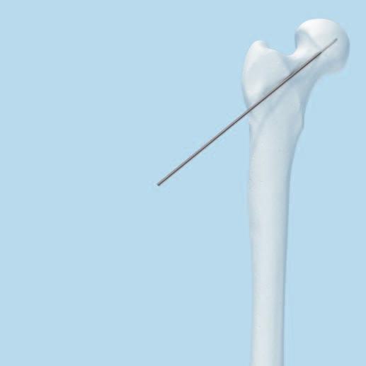 Standard DHS Lag Screw with LCP DHHS Sideplate Technique 1 Insert anteversion wire Instruments 338.000 DHS/DCS Guide Wire 2.5 mm with threaded tip with trocar, length 230 mm Reduce the fracture.