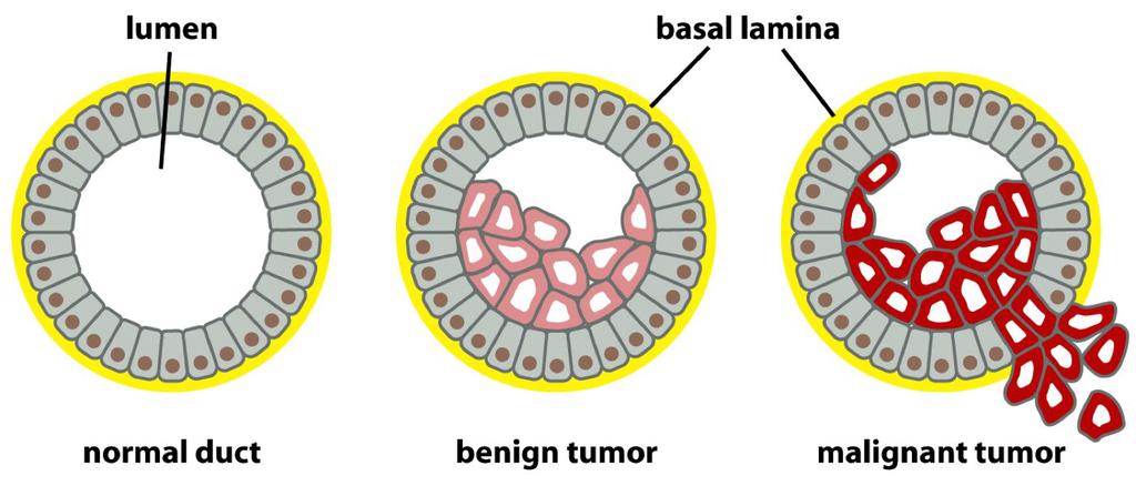 cancer is known as drosarcoma or adenocarcinoma (Figure 3.1).