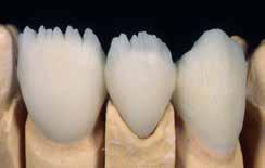 Pastes NF (+firing) Application of Opal/Incisal