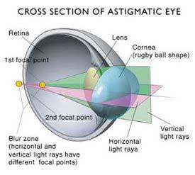 Astigmatism- Condition where the cornea is shaped like a football, light rays fall in 2 different