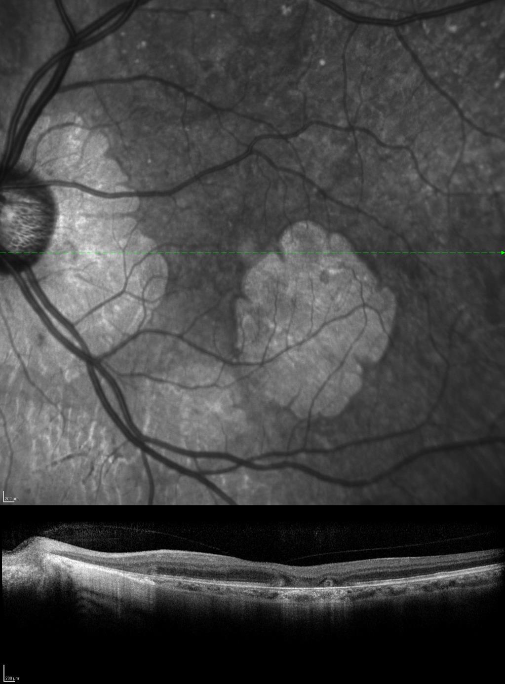 Supplemental Figure 4: IR and OCT images from the left eye of symptomatic carrier 13132 showing large regions of RPE atrophy in the macula, including the foveal region.