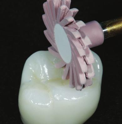The ASAP INDIRECT+ diamond polishing system is all you need to refine and create an outstanding shine on all your indirect ceramic restorations.