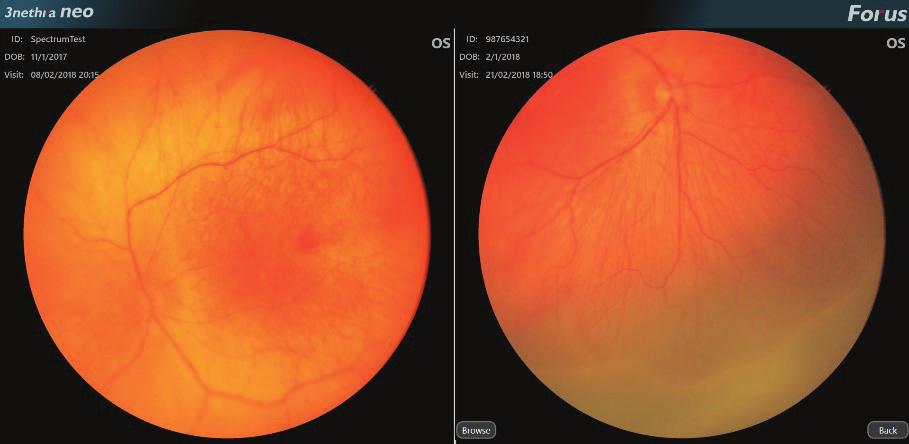 Review Software This convenient and full-screen view of the fundus images allows for easier comparison between images
