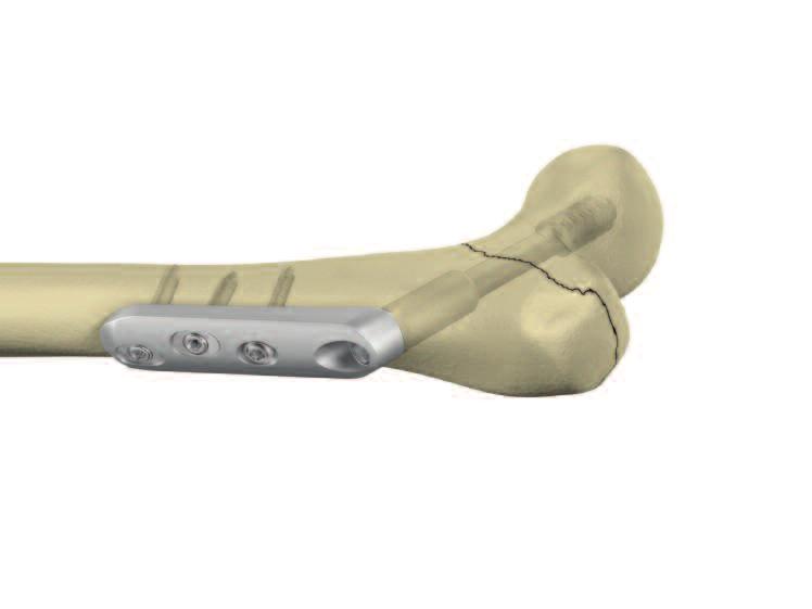 Omega3 Hip Plate Fixation with Axial Stable Locking Screws continued Step 6 Screw Insertion: Insert the Locking Screw into the Locking Insert, using the Screwdriver T20, AO fitting assembled with the